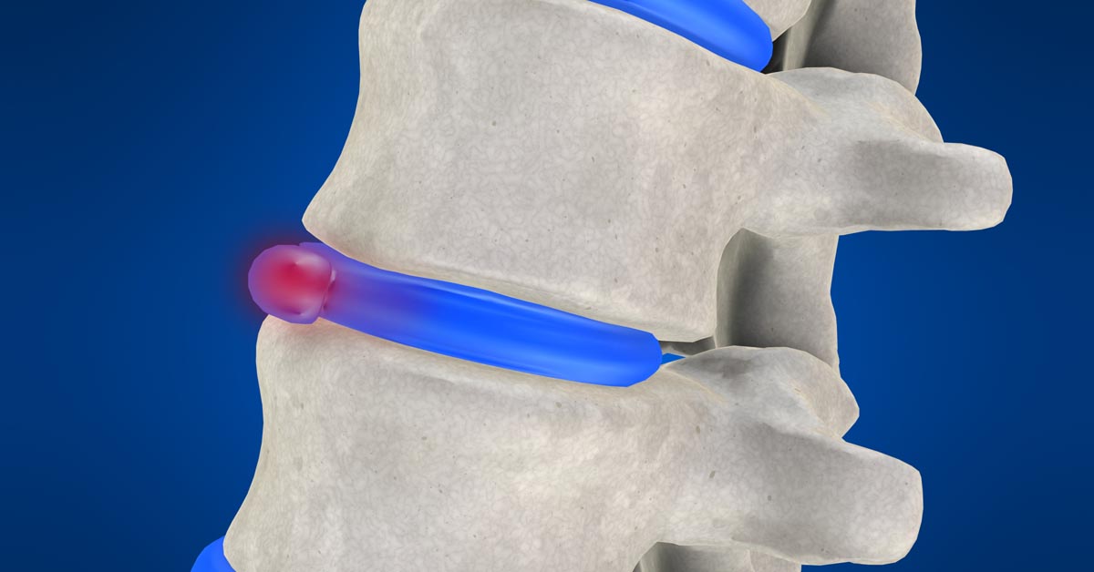 State College, PA non-surgical disc herniation treatment